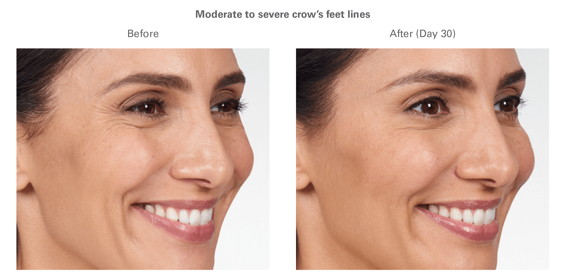 Botox Before and After Culver City 2