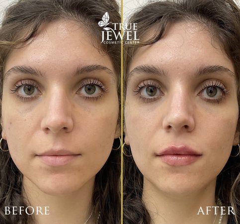 Culver City Lip Filler Before and After 00003