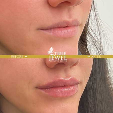 Culver City Lip Filler Before and After 00005