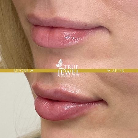 Culver City Lip Filler Before and After 00012