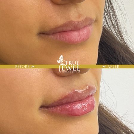 Culver City Lip Filler Before and After 00014