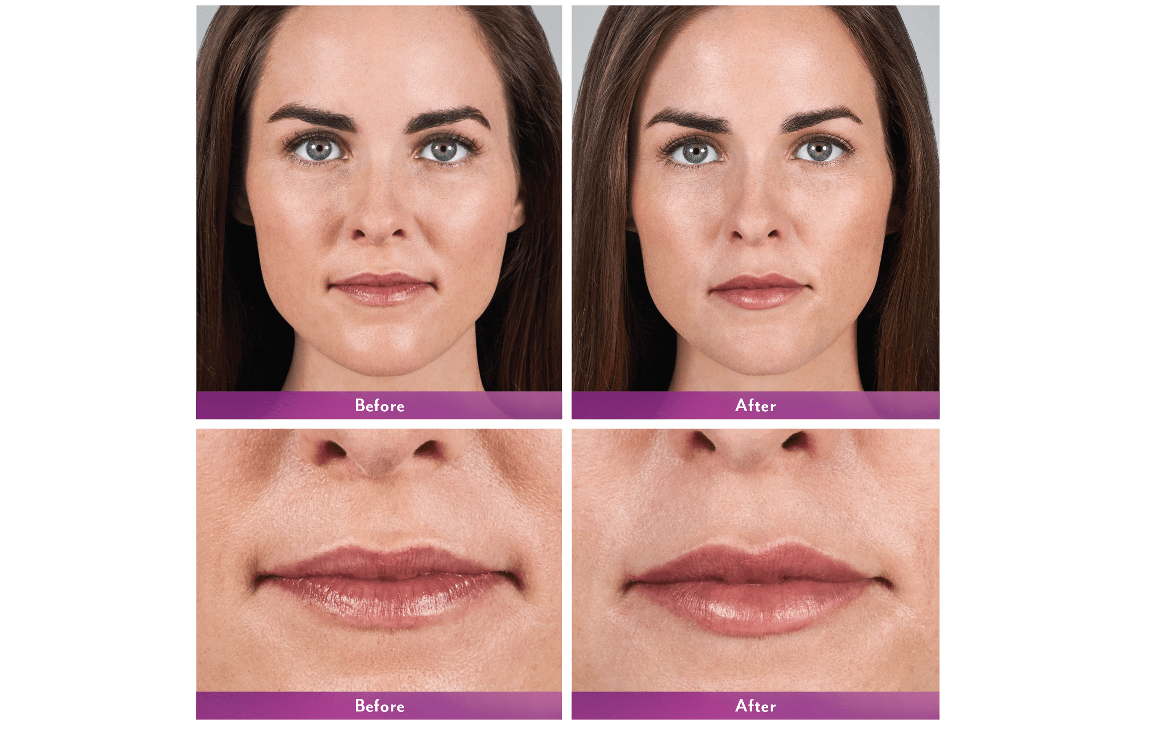 Volbella Before and After 1 Culver City