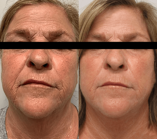 Morpheus8 Treatment in Culver City CA 17