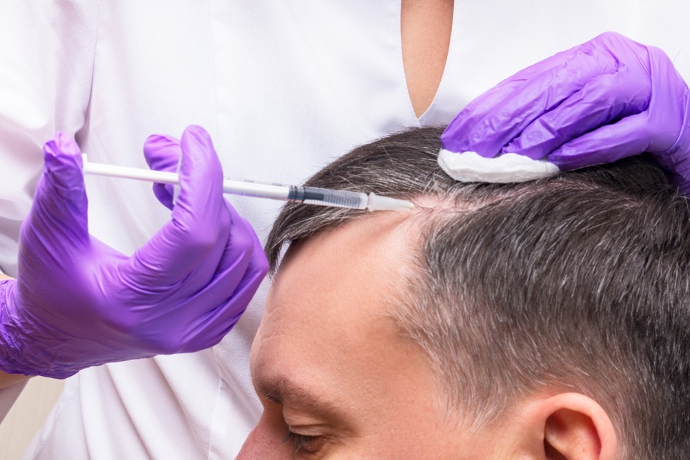 Can PRP Regrow Hair on a Bald Head?