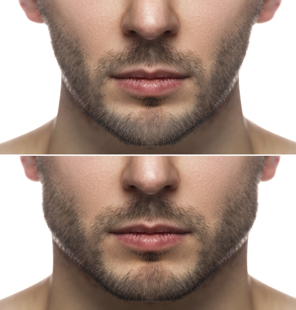 Your Guide to Jawline Filler for Men